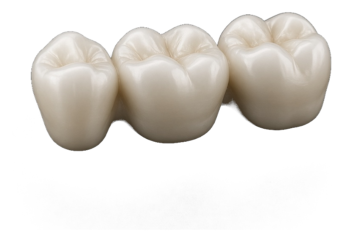 Three-unit ceramic bridge shown in the design preview.